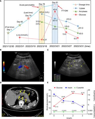 Immune checkpoint inhibitors-related pancreatitis with fulminant type 1 diabetes mellitus: case report and literature review